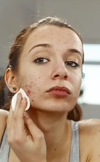 12 best local approach to treat face pimples