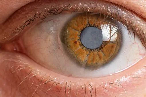 11 best approach to manage cataract in adults, a defect of the retina